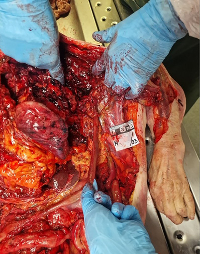 The image shows the same injury as Fig. 4, but from the inside. The layers of skin, subcutaneous tissue, fascia and muscles are visible, loops of the intestines partially protrude through the laceration in the arm.