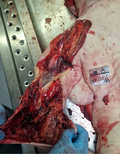 The picture shows the same as Fig. 6, but from the inside. The loops of the intestines extend from the upper arm to the forearm. Several loops of intestine can be seen partially protruding outwards through the laceration of the forearm and wrist. The illustration presents the layers of tissue and the position of the intestines within the cavity.