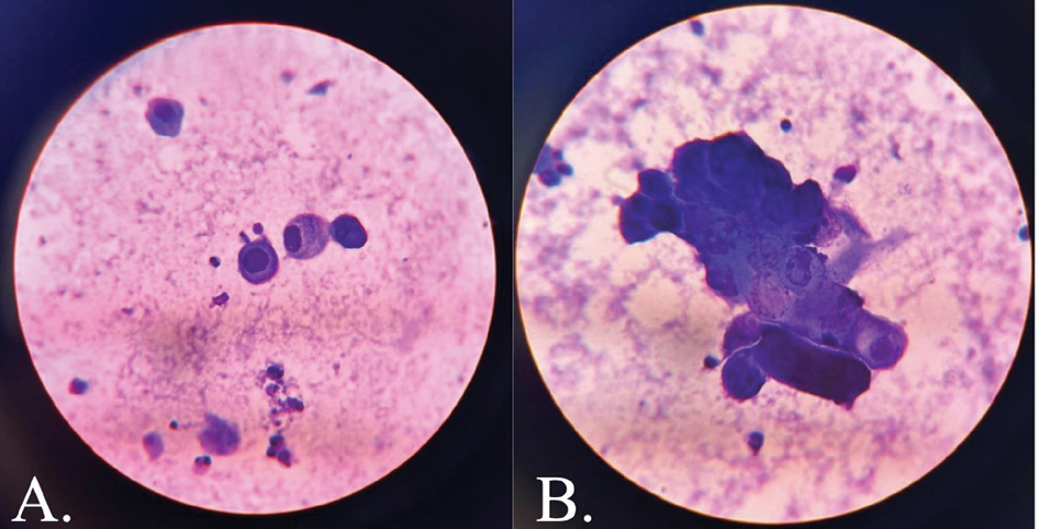Panel A displays a microscopic view of Tzanck smear stained with Giemsa, highlighting acantholytic keratinocytes with rounded, detached nuclei. Panel B shows multinucleated giant cells with abundant cytoplasm and overlapping nuclei, indicative of herpesvirus infection.