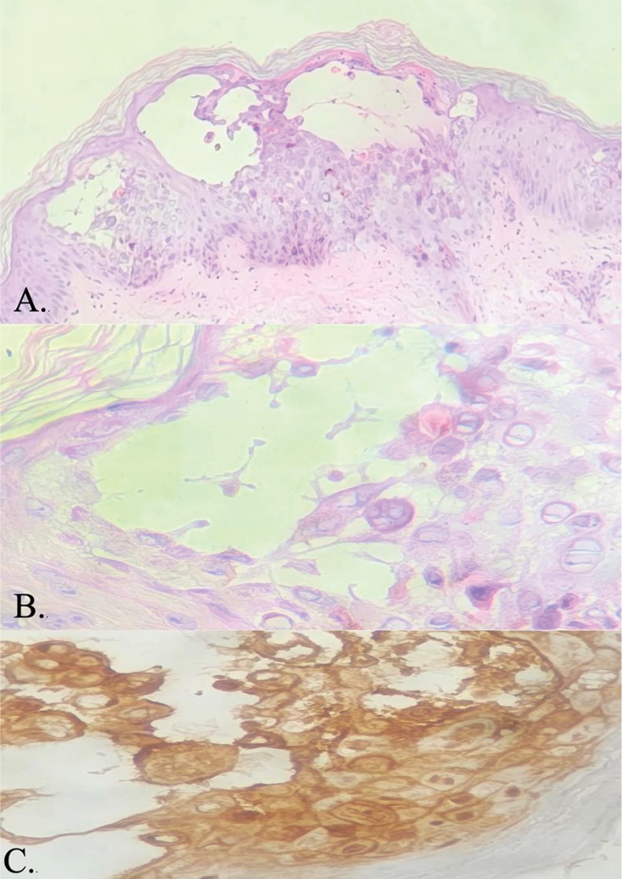 Panel A shows a low-power histology image (H&E, 100x) of an intraepidermal blister with acantholysis and spongiosis. Panel B is a high-power (H&E, 400x) image revealing viral cytopathic changes including multinucleation, nuclear molding, and chromatin margination. Panel C shows a brown immunostaining pattern on IHC, confirming the presence of HSV-1 and HSV-2 antigens in epidermal cells.