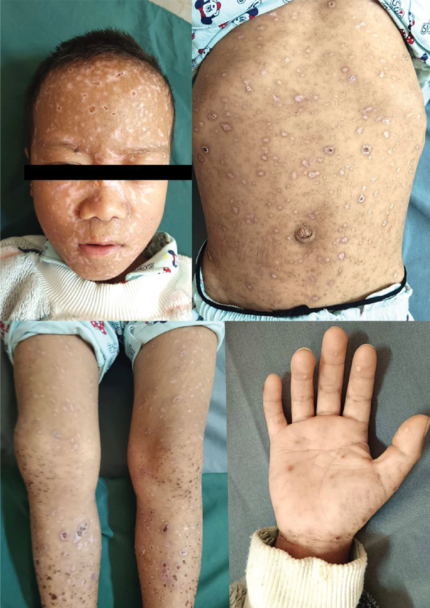 Composite image showing the same child after treatment. Hypopigmented macules are scattered across the face, trunk, limbs, and palms, replacing the previous vesiculopustular lesions. The skin appears drier and smoother with absence of crusting or oozing. Evidence of post-inflammatory hypopigmentation is most prominent on the face, trunk and lower limbs.