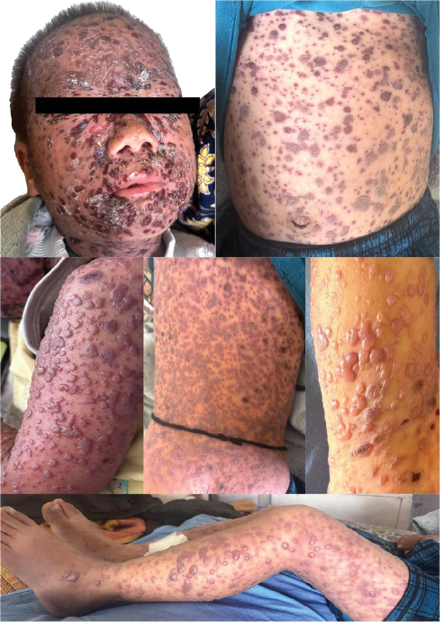 A composite image showing multiple body regions affected by a monomorphic vesiculopustular eruption. The child’s face is covered in tense vesicles and crusts with areas of hemorrhage and oozing. The trunk and limbs show widespread, discrete to confluent, flat-topped vesicles and pustules, some with hemorrhagic crusts. Lesions involve both extensor and flexural surfaces, including the abdomen, arms, thighs, and lower legs. The eruptions are distributed bilaterally and are accompanied by background erythema and skin tenderness.
