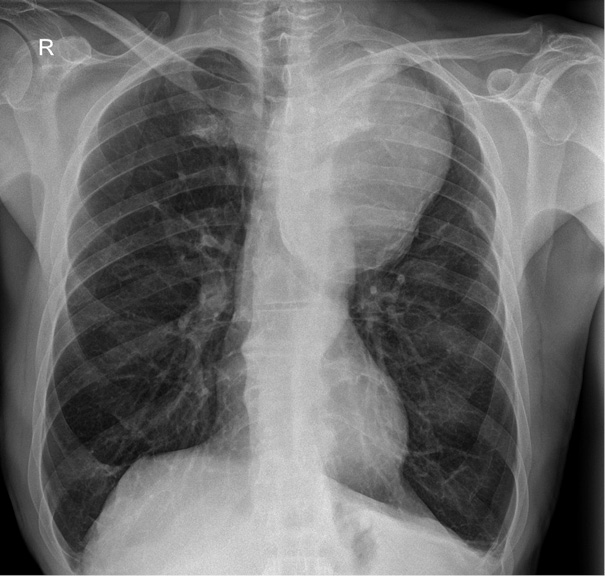 Black-and-white preoperative chest X-ray in posteroanterior projection. A large rounded opaque mass is visible in the left mediastinal region, between the lung fields. The trachea is visibly shifted to the right side. Lung parenchyma appears otherwise clear