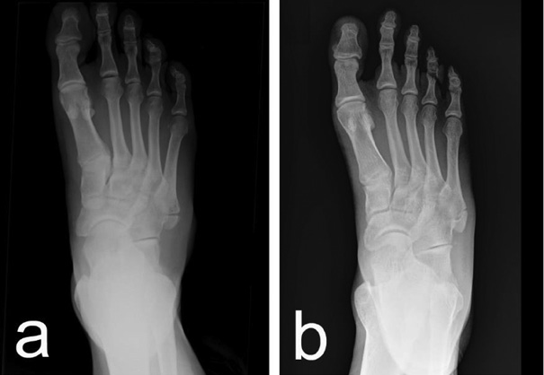 Two side-by-side grayscale X-ray images of human feet, each labeled with a lowercase letter in the bottom left corner. Panel a: X-ray of a left foot belonging to a 20-year-old man, showing bones from the toes to the ankle. Near the outer side of the midfoot, just behind the base of the smallest toe’s metatarsal bone, there is a small, rounded bone fragment (ossicle) with smooth, clear edges. Panel b: X-ray of a left foot belonging to a 43-year-old woman, taken in a similar position. The same type of small, rounded bone fragment is visible in the same location near the base of the fifth metatarsal. Both images depict the rare accessory bone known as the os vesalianum pedis, appearing as an isolated, well-defined piece of bone adjacent to the outer midfoot.