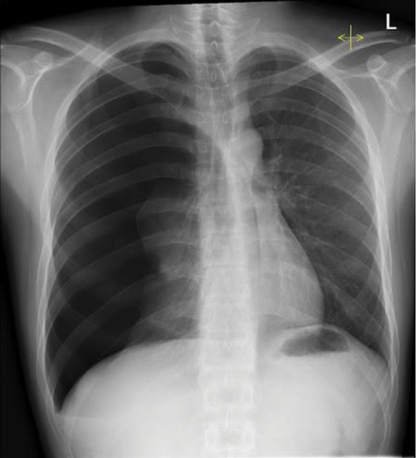 Upright anteroposterior chest X-ray demonstrating a right-sided pneumothorax with partial lung collapse (approximately 30% volume) prior to tube thoracostomy placement.
