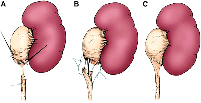 Inkstų arterinė hipertenzija: gydymas ir simptomai - Vaskulitas November