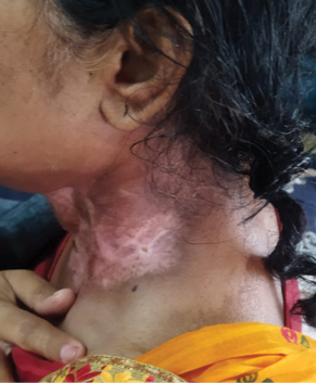 A woman with a skin condition on her neck.
Description generated by AI