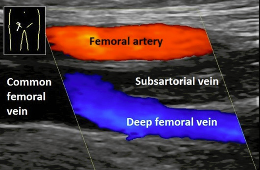 A graphic showing the deep and superficial veins.
Description generated by AI