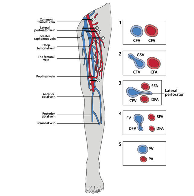 A diagram of a leg with a red vein and blue arteries.
Description generated by AI
