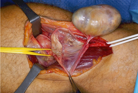A person's leg with a surgical procedure being performed.
Description generated by AI